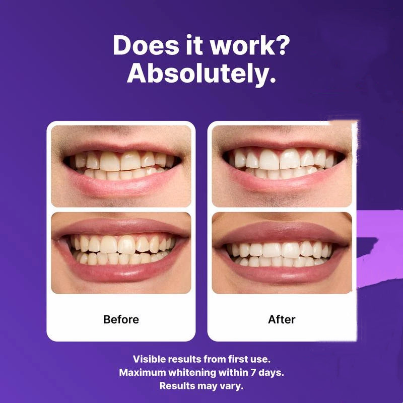 Purple Teeth Whitening Strips — Gen 2